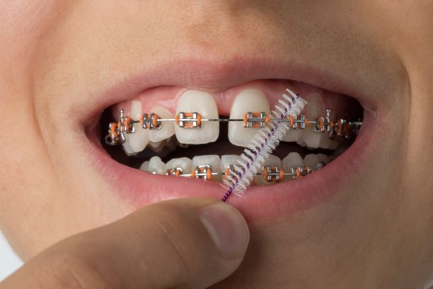 close up of cleaning dental braces 2021 04 03 14 13 50 utc