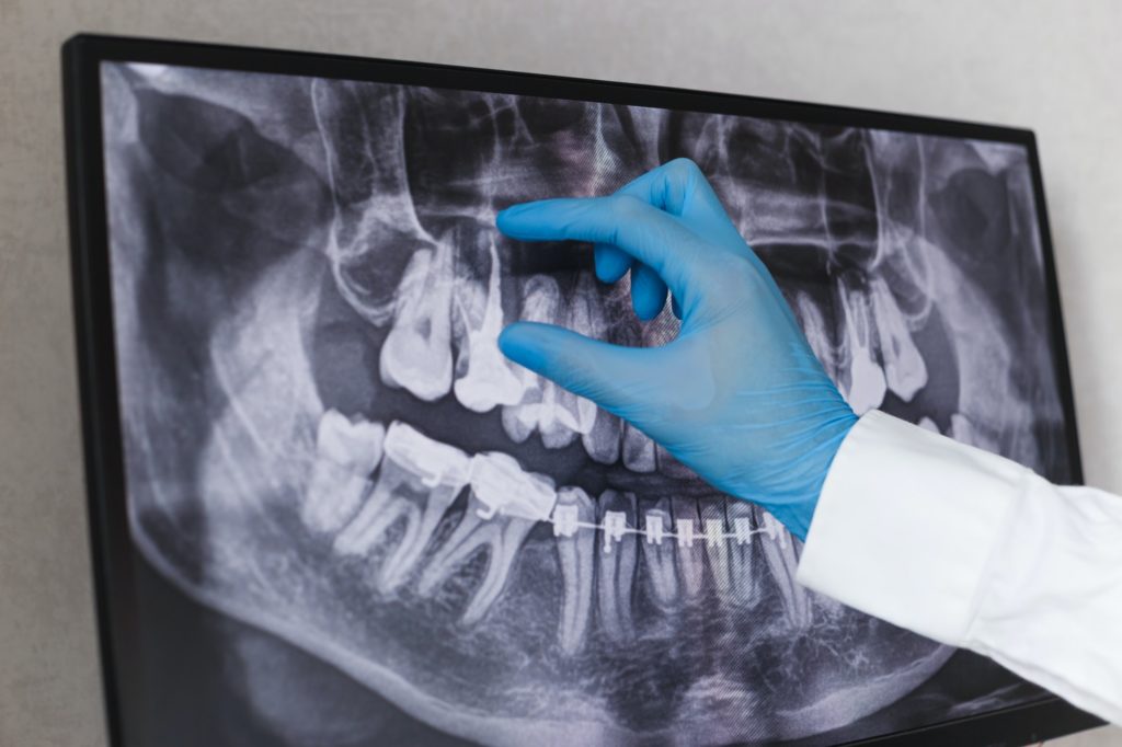 root canal in oxnard