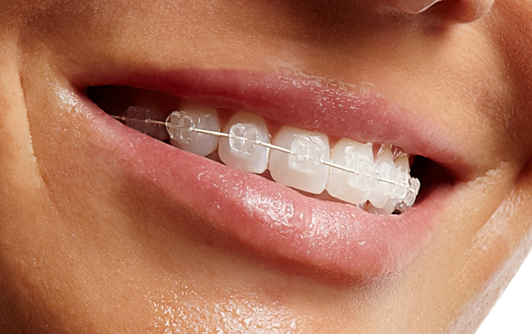 Clear Braces - Brackets Transparentes