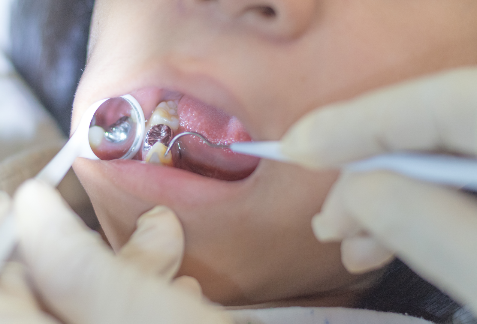 amalgam filling