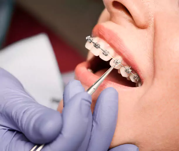 orthodontics treatment