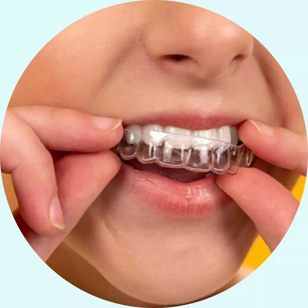 Invisalign Aligners