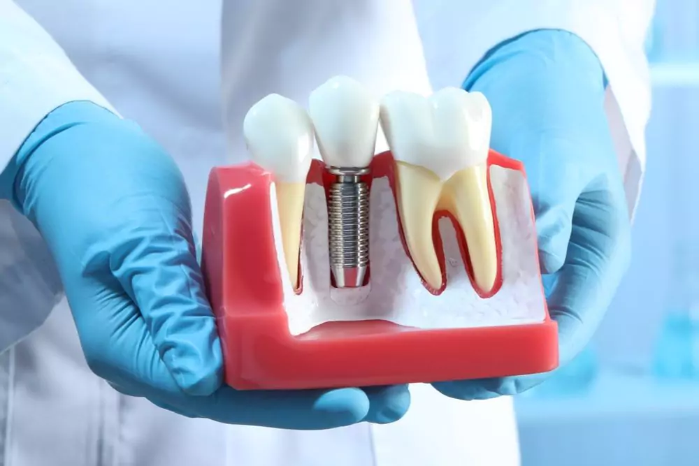 Dental Implant Model